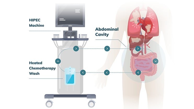 peritoneal carcinomatosis cancer treatment